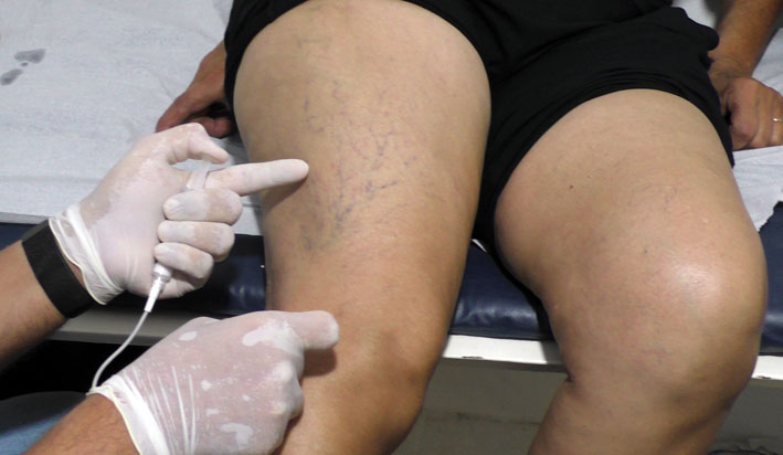 Prefeitura de Baixa Grande inicia tratamento de varizes com espuma em 180 pacientes