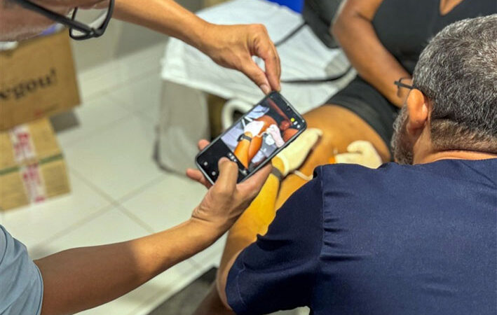 Prefeitura de Baixa Grande realiza segunda aplicação do tratamento de esclerose com espuma